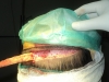 implant-par-metoda-strip