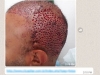 hair-fue-donor-holes-brazilia