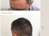 hair-transplant-implant-par-pret-turcia-2