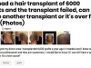 hair-transplant-implant-par-pret3