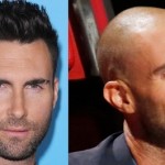 Adam Levine, un exemplu in care transplantul de par face diferenta