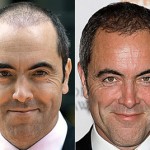 Interviu cu actorul James Nesbitt despre transplantul de par