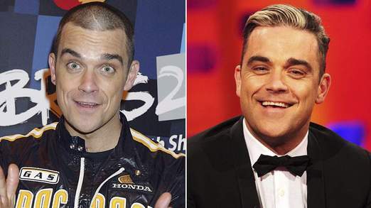 Robbie Williams Hair Transplant | Implant de par