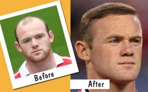 transplantul de par al lui WayneRooney