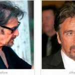 al-pacino-hair-transplant-implant