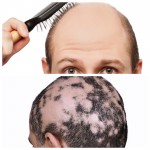 alopecia androgenetica vs areata