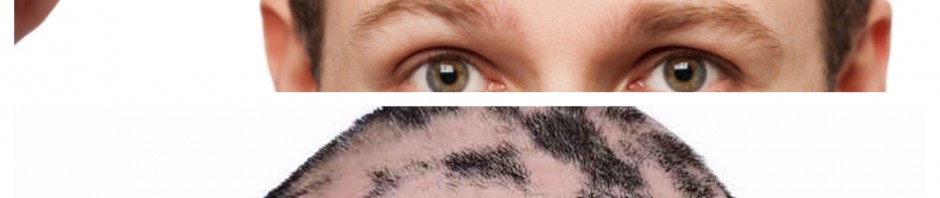 alopecia androgenetica vs areata