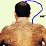 body-hair-transplant-par-corp-scalp