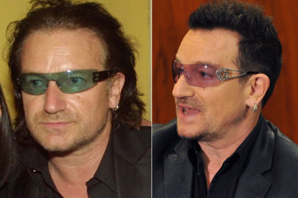 Bono U2 | Hair transplant | Implant de par