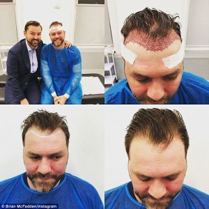 brian mcfadden after hair transplant surgery