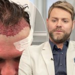 brian-mcfadden after hair transplant result