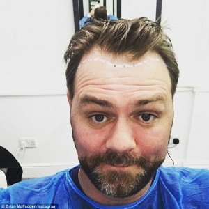 brian mcfadden hair transplant before