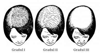 Caderea parului la femei | Transplant de par femei