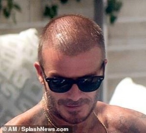 david-beckham-hair-transplant-before