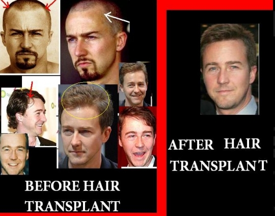 Edward Norton Hair Transplant de par | Implant de par