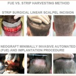 Transplant de par – FUE versus STRIP