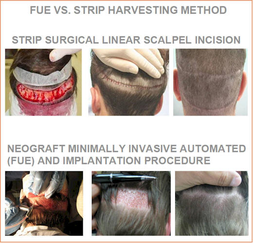 Fue versus Strip Transplant de par