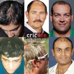 hair-transplant-cricket-players