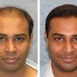 hair-transplant india