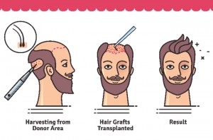 transplant de par poze | rezultat implant de par fue