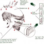 Implantul de par – Metoda STRIP