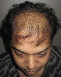 india-hair-transplant-implant