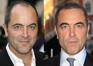 james-nesbitt-before-and-after-hair-implant