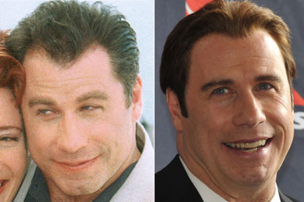 john-travolta-before-and-after-hair-transplant