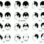 Patternul masculin de alopecie | Male baldness pattern