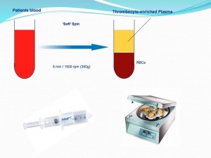 Obtinerea PRP - platelet rich plasma