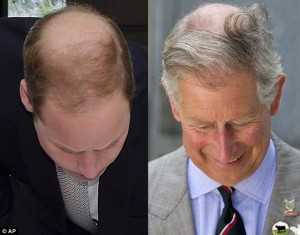 prince-william-bald-hair-transplant