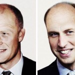 princes-baldness-harry-william-hair-transplant