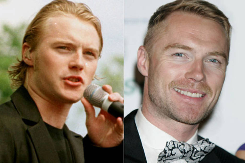 Ronan Keating Boyzone - Hair Transplant