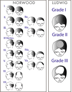 Alopecia androgenica – Scara Norwood-Hamilton barbati si Scara Ludwig femei