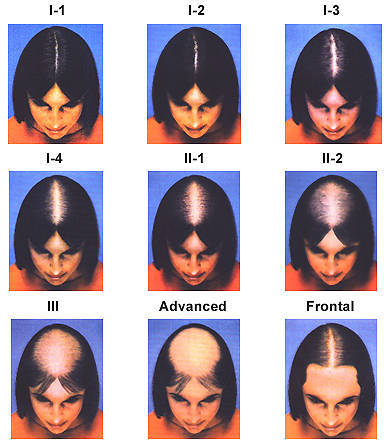 Scara Ludwig Alopecie femei