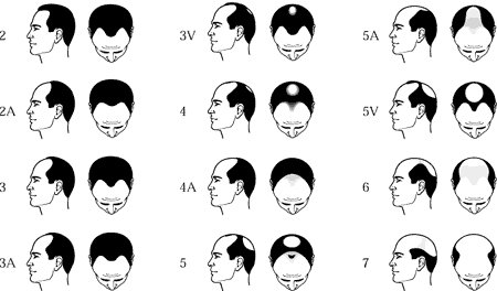 Scara Norwood H amilton - Alopecia masculina, androgenica, barbati