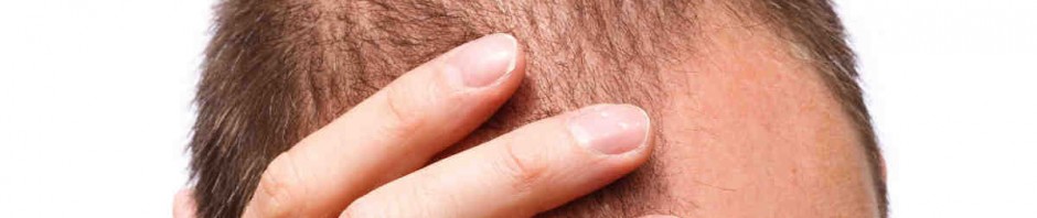 Caderea Parului Cauzata De Stres Alopecia Din Cauza Stresului