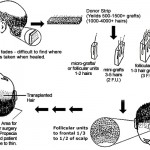 Glosar Transplant de par | Termeni implant par