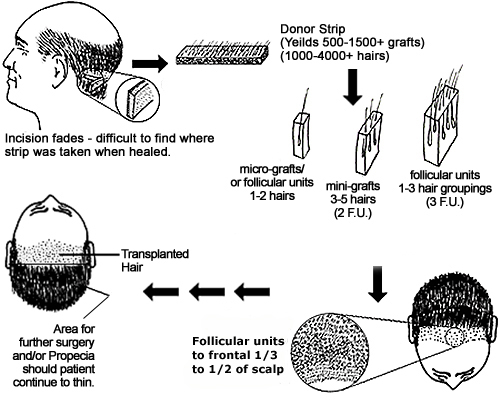 Glosar Transplant de par | Termeni implant par