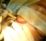 video-implant-transplant-sprancene