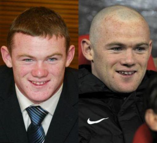 Ronney before and after Ronney before and after hair transplant
