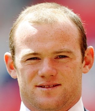 Wayne Rooney inainte de operatie | Chelia lui Rooney